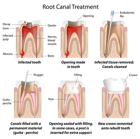 Root Canal Albany NY Delmar NY